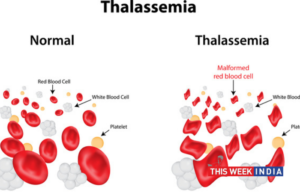 Myths and Reality associated with Thalassemia - thisweekindia