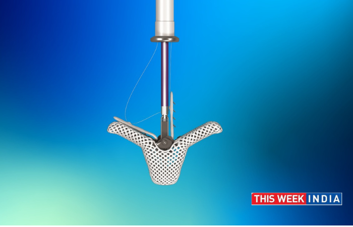Abbott Launches Innovative TriClip™ System in India - thisweekindia